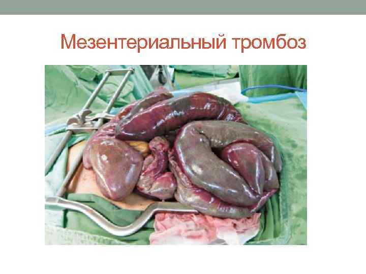 Мезентериальный тромбоз 