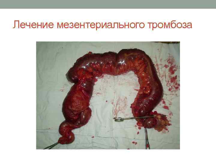 Лечение мезентериального тромбоза 