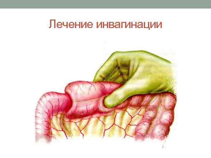 Лечение инвагинации 