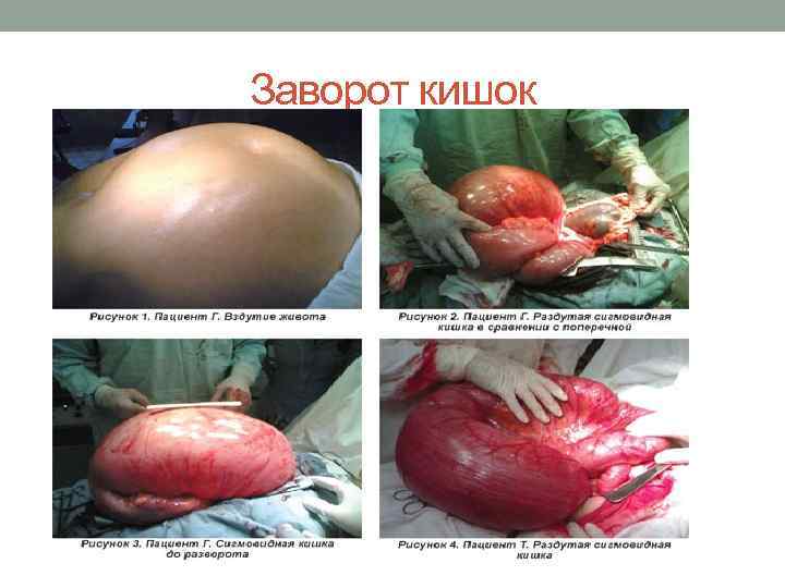 Заворот кишок 