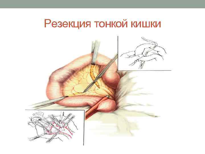 Резекция тонкой кишки 