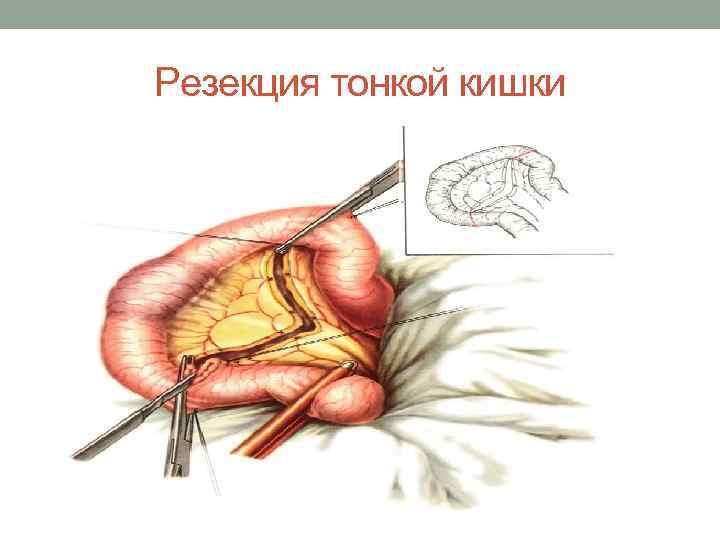 Резекция тонкой кишки 