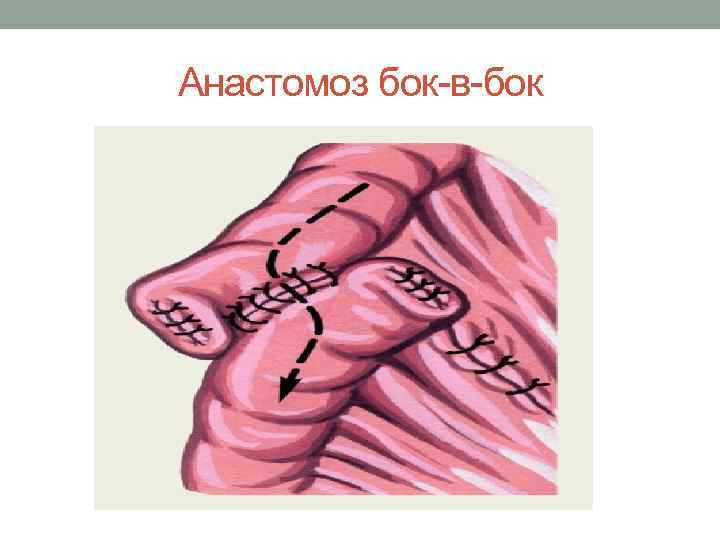 Анастомоз бок-в-бок 