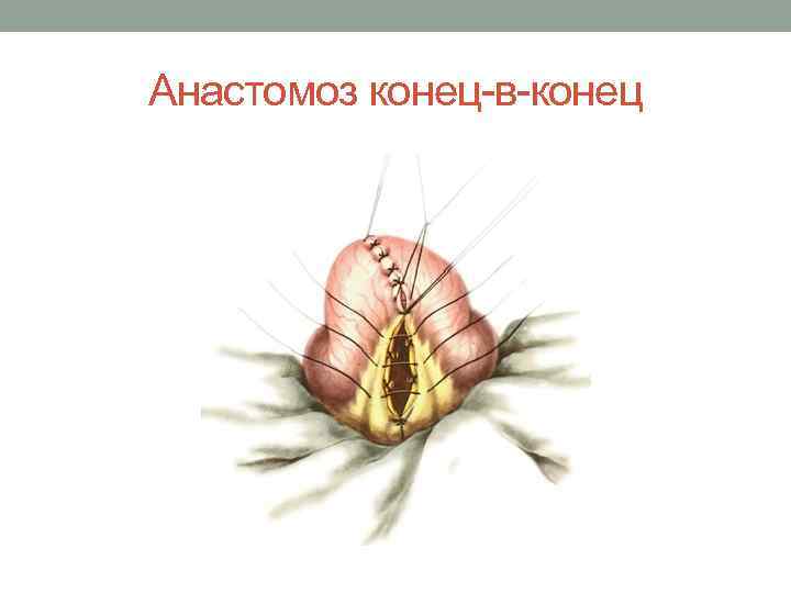 Анастомоз конец-в-конец 