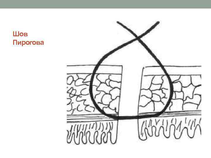  Шов Пирогова 
