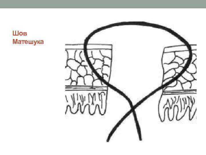 Шов Матешука 