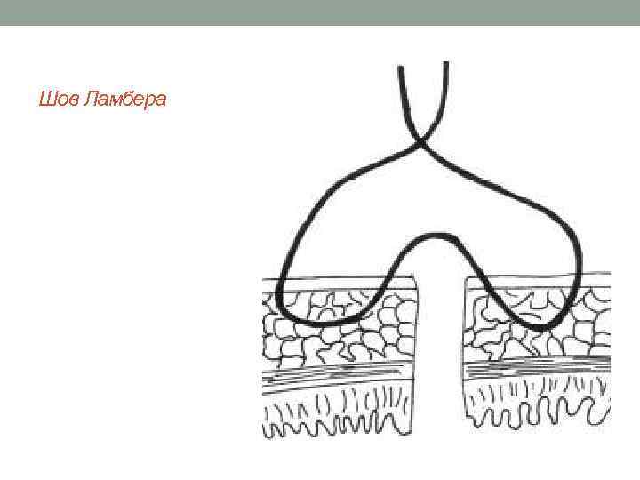 Шов Ламбера 