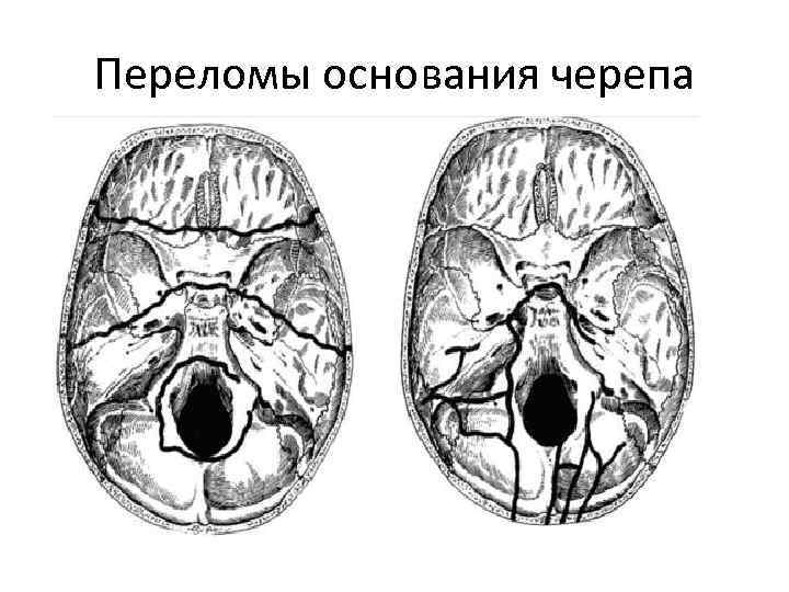 Перелом основания черепа карта вызова