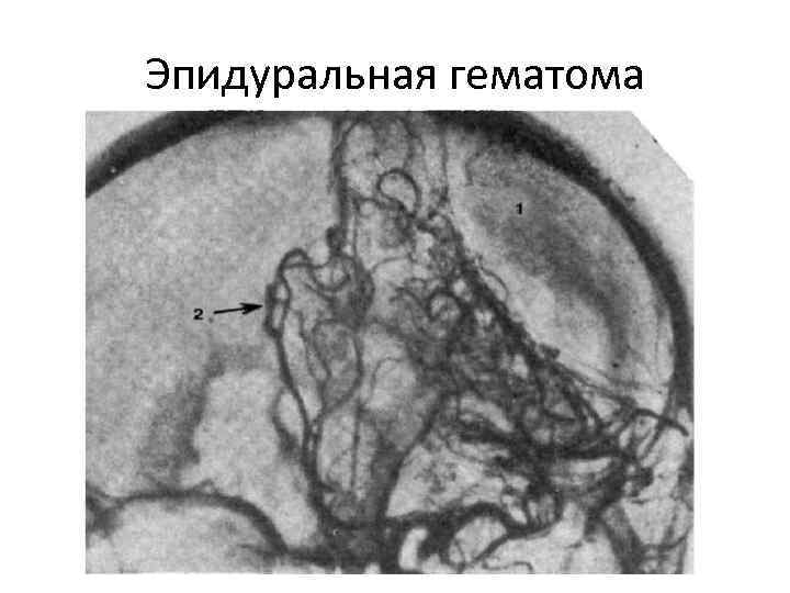 Эпидуральная гематома 