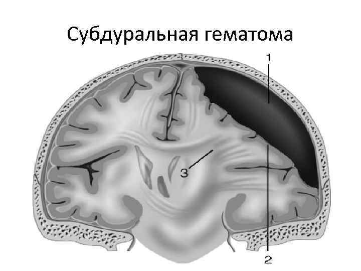 Субдуральная гематома 