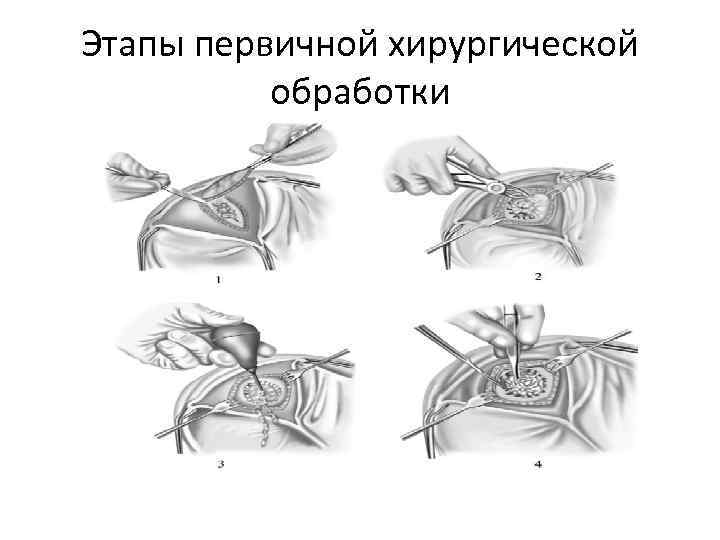 Первичная хирургическая рана. Этапы первичной хирургической обработки раны. Пхо огнестрельной раны этапы.