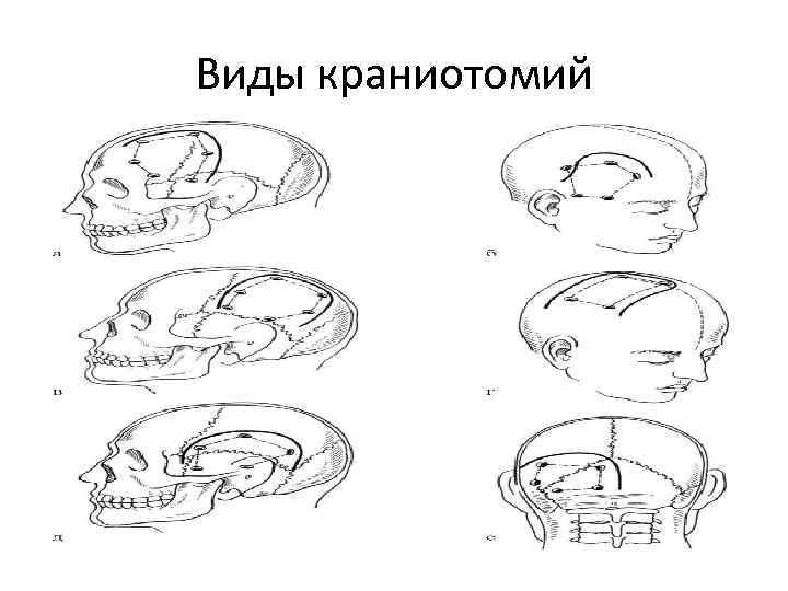 Виды краниотомий 