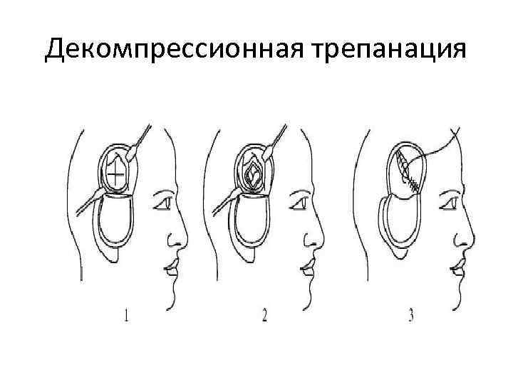 Схема трепанации черепа по способу оливекрона