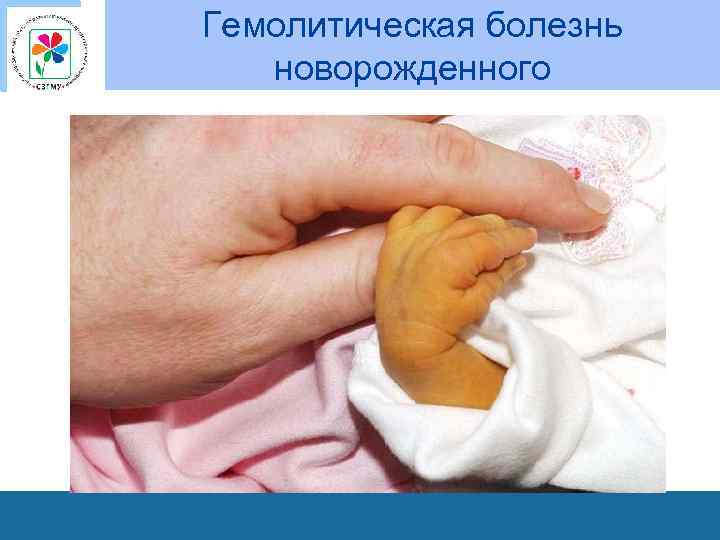 Гемолитическая болезнь новорожденного 