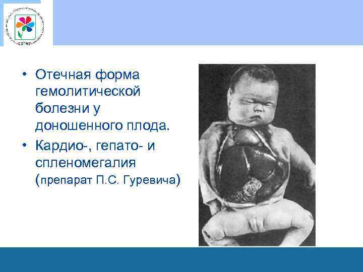  • Отечная форма гемолитической болезни у доношенного плода. • Кардио-, гепато- и спленомегалия
