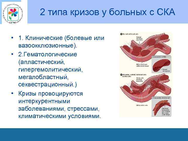 2 типа кризов у больных с СКА • 1. Клинические (болевые или вазоокклюзионные). •