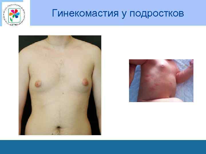 Гинекомастия у подростков 