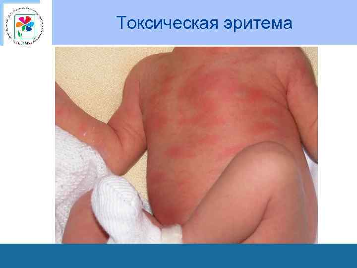 Токсическая эритема 