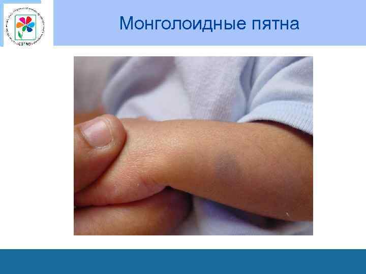 Монголоидные пятна 
