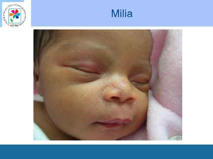 Milia 