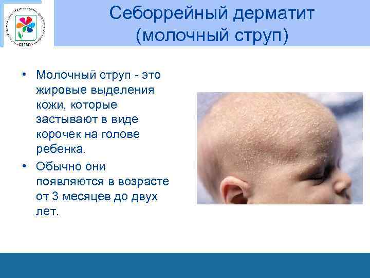 Себоррейный дерматит (молочный струп) • Молочный струп это жировые выделения кожи, которые застывают в