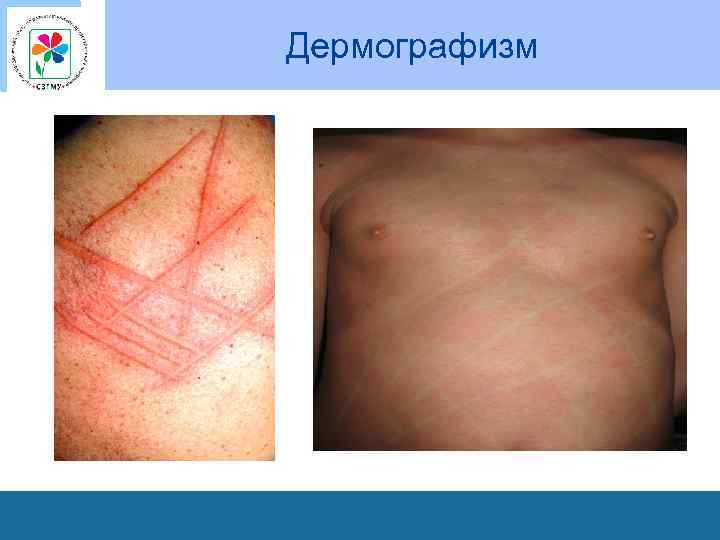 Дермографизм 