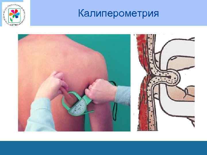 Калиперометрия 