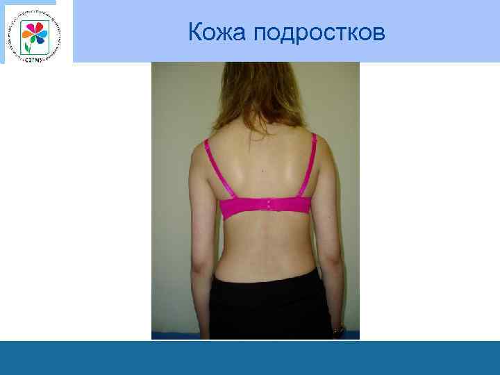 Кожа подростков 