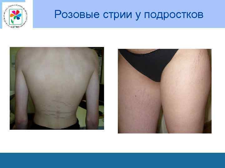 Розовые стрии у подростков 