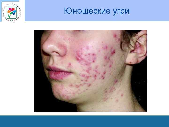 Юношеские угри 