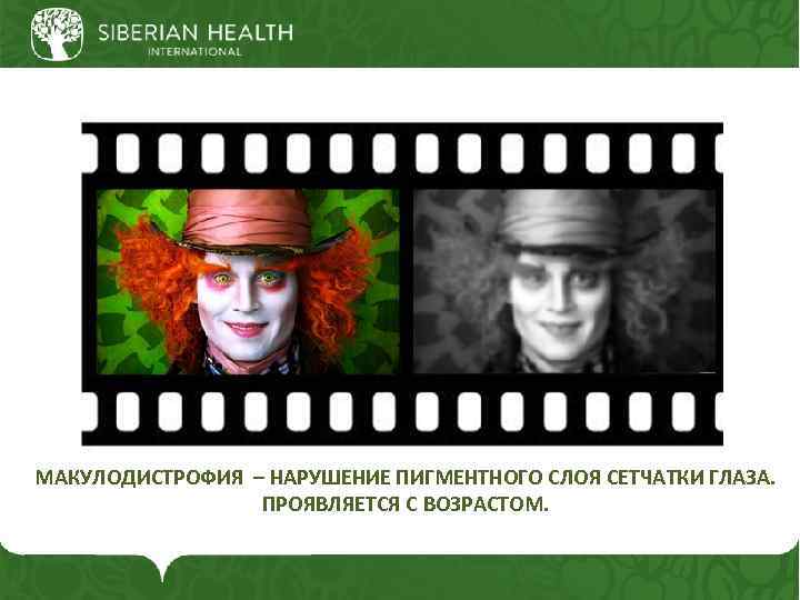 МАКУЛОДИСТРОФИЯ – НАРУШЕНИЕ ПИГМЕНТНОГО СЛОЯ СЕТЧАТКИ ГЛАЗА. ПРОЯВЛЯЕТСЯ С ВОЗРАСТОМ. 