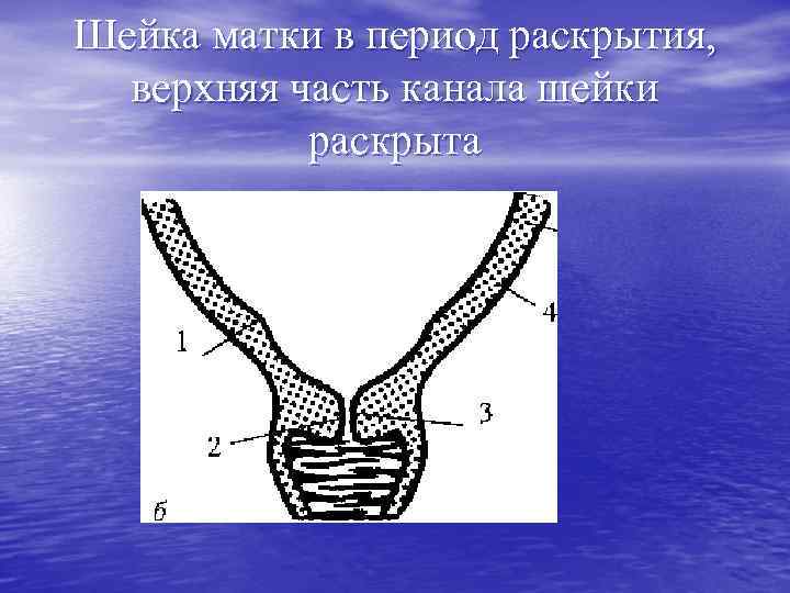 Шейка матки в период раскрытия, верхняя часть канала шейки раскрыта 