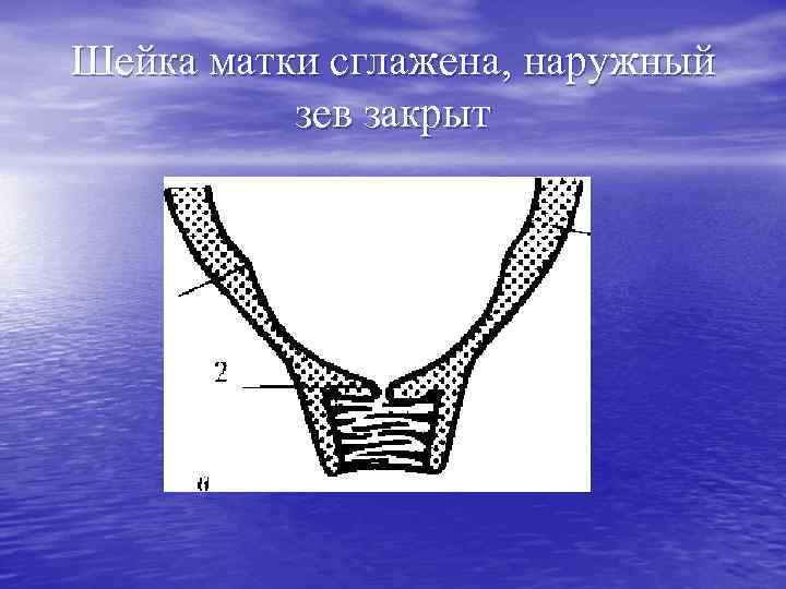 Шейка матки сглажена, наружный зев закрыт 