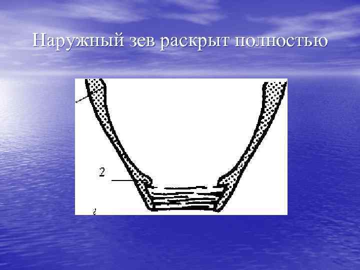 Наружный зев раскрыт полностью 