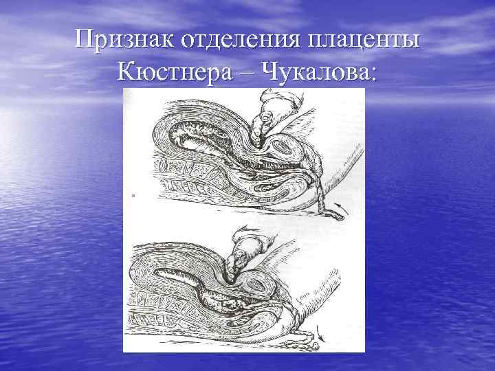Признак отделения плаценты Кюстнера – Чукалова: 