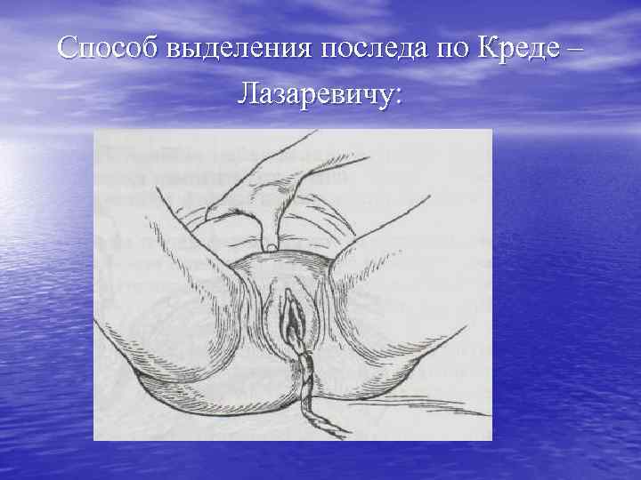 Способ выделения последа по Креде – Лазаревичу: 
