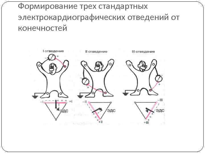 Формирование трех стандартных электрокардиографических отведений от конечностей 