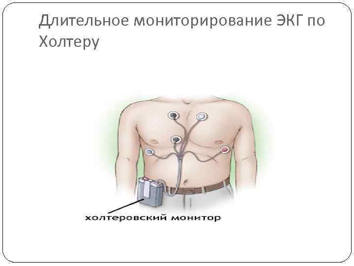 Длительное мониторирование ЭКГ по Холтеру 