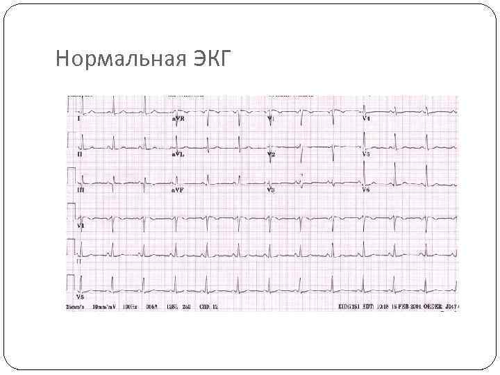 Нормальная ЭКГ 