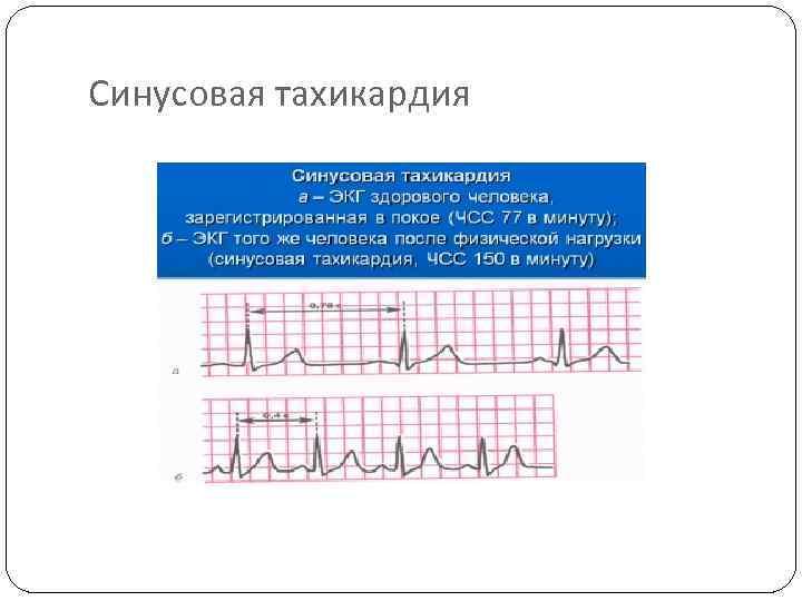 Синусовая тахикардия 