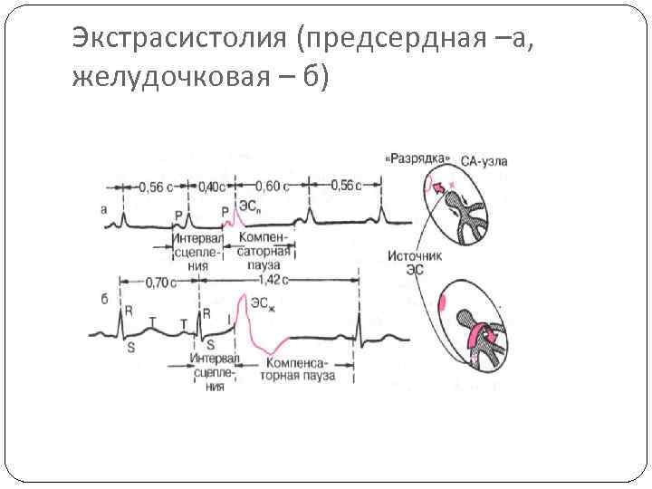 Экстрасистолия (предсердная –а, желудочковая – б) 