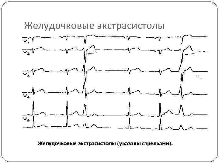 Желудочковые экстрасистолы (указаны стрелками). 