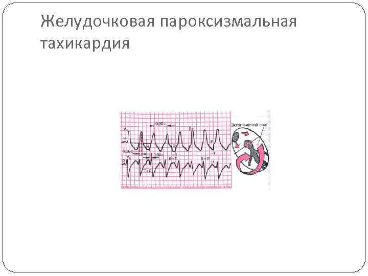 Желудочковая пароксизмальная тахикардия 