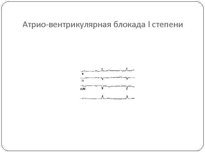 Атрио-вентрикулярная блокада I степени 