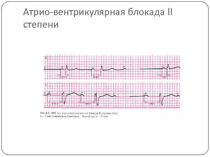 Атрио-вентрикулярная блокада II степени 