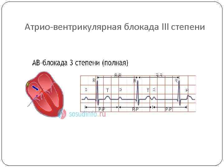 Атрио-вентрикулярная блокада III степени 