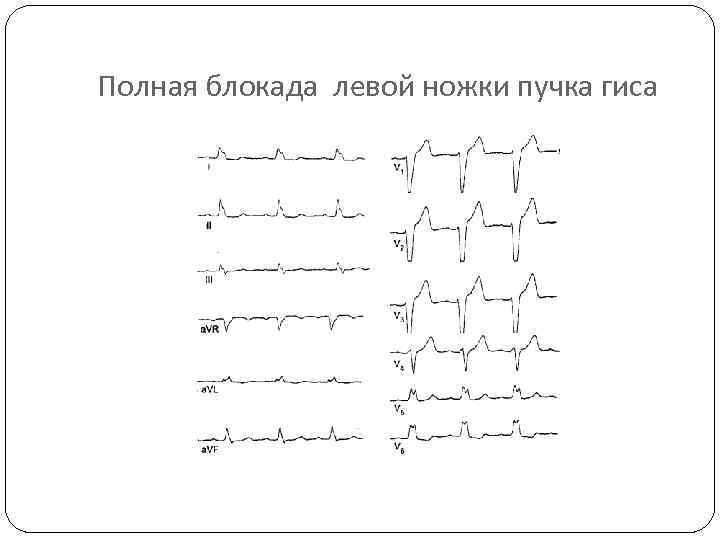 Полная блокада левой ножки пучка гиса 