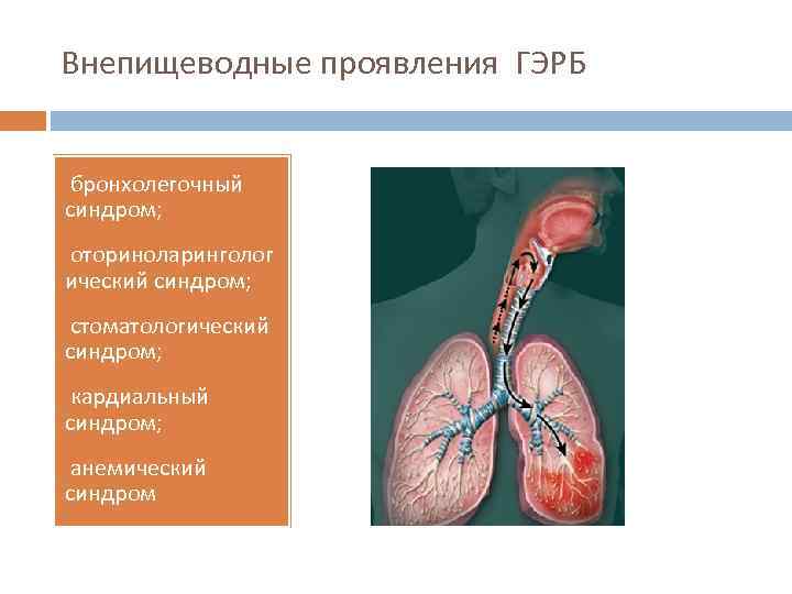 Внепищеводные проявления ГЭРБ бронхолегочный синдром; • оториноларинголог ический синдром; • стоматологический синдром; • кардиальный