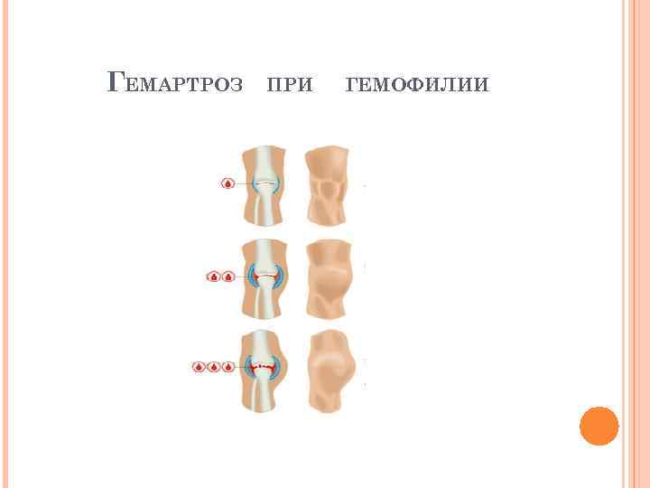 Гемартроз. Гемартроз при гемофилии. Гемартроз коленного сустава при гемофилии.