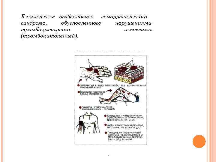Клинические особенности геморрагического синдрома, обусловленного нарушениями тромбоцитарного гемостаза (тромбоцитопенией). 